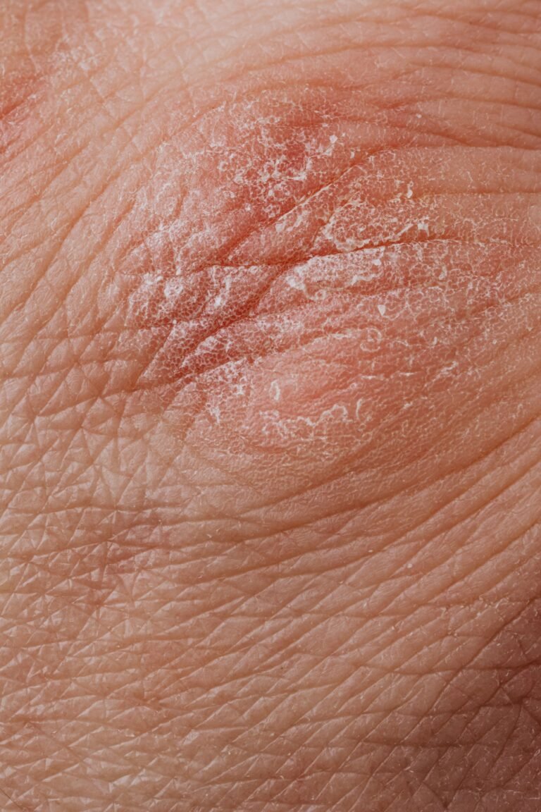 Eosinófilos Altos, o Que Significa? As 4 Faixas e o Alerta do Corticoide
